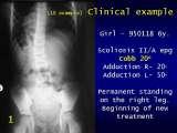 Two LECTURE on SCOLIOSIS in REGENSBURG / 10-14.05.2007