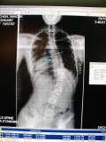 Scoliosis Meeting in HONG KONG, Oct.2004 / Photos
