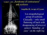 Two LECTURE on SCOLIOSIS in REGENSBURG / 10-14.05.2007