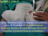 DDH/Cong.luxation of hip/LUBLIN method ot therapy/LECTURE