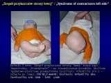 SYNDROME of CONTRACTURES-Hip Dysplasia / DDH / WryNeck/M.Blount/SCOL./LECTURES