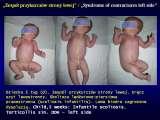SYNDROME of CONTRACTURES-Hip Dysplasia / DDH / WryNeck/M.Blount/SCOL./LECTURES
