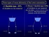 SYNDROME of CONTRACTURES-Hip Dysplasia / DDH / WryNeck/M.Blount/SCOL./LECTURES