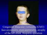 SYNDROME of CONTRACTURES-Hip Dysplasia / DDH / WryNeck/M.Blount/SCOL./LECTURES