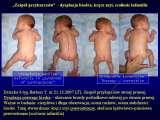 SYNDROME of CONTRACTURES-Hip Dysplasia / DDH / WryNeck/M.Blount/SCOL./LECTURES