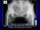 Wody geotermalne w ortopedii. Geothermal water in orthopaedic therapy.