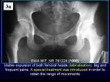Wody geotermalne w ortopedii. Geothermal water in orthopaedic therapy.