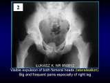Wody geotermalne w ortopedii. Geothermal water in orthopaedic therapy.