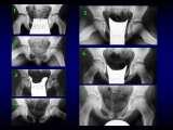 Wody geotermalne w ortopedii. Geothermal water in orthopaedic therapy.