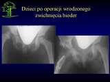 Wody geotermalne w ortopedii. Geothermal water in orthopaedic therapy.