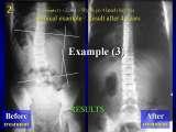 New Fundamental Knowledge on Scoliosis. SCIENCE versus OPINION / LECTURE
