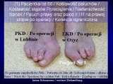 Test fleksyjny palcw stopy / Flexions test of toes LECTURE