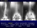 TWO LECTURES on scoliosis / Orthop.Congress in CAIRO-8.12.2006