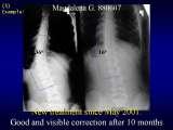 TWO LECTURES on scoliosis / Orthop.Congress in CAIRO-8.12.2006