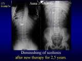 Two LECTURE on SCOLIOSIS in REGENSBURG / 10-14.05.2007