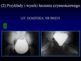 DDH/Cong.luxation of hip/LUBLIN method ot therapy/LECTURE