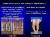 SYNDROME of CONTRACTURES-Hip Dysplasia / DDH / WryNeck/M.Blount/SCOL./LECTURES