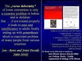 SYNDROME of CONTRACTURES-Hip Dysplasia / DDH / WryNeck/M.Blount/SCOL./LECTURES