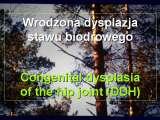 SYNDROME of CONTRACTURES-Hip Dysplasia / DDH / WryNeck/M.Blount/SCOL./LECTURES