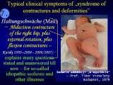 SYNDROME of CONTRACTURES-Hip Dysplasia / DDH / WryNeck/M.Blount/SCOL./LECTURES