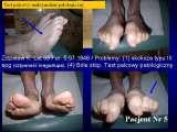 Test fleksyjny palców stopy / Flexions test of toes LECTURE