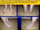 Test fleksyjny palcw stopy / Flexions test of toes LECTURE